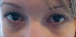 After transconjunctival lower eyelid blephartoplasty