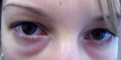 Long-standing baggy eyelids in a young patient