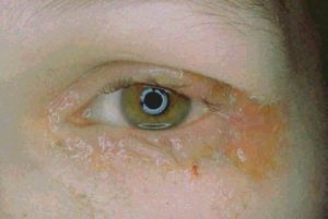 Chronic allergic changes affecting the eyelid skin