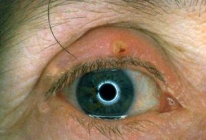 Inflamed eyelid margins with multiple chalazia (meibomian cysts)