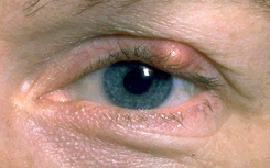 Chalazia Chronic inflammation of an eyelid oil gland (Chalazia) that stimulates the formation of a surrounding cyst