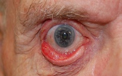 Ecrtropion Before Lower eyelid ectropion