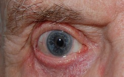 Ectropion After Ectropion surgery restores the eyelid to its normal orientation
