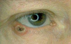 Lower eyelid basal cell carcinoma Lower eyelid basal cell carcinoma (rodent ulcer)