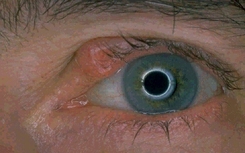Upper eyelid sebaceous gland carcinoma Upper eyelid sebaceous gland carcinoma
