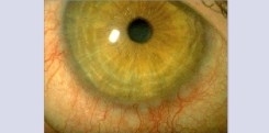 Dry eye sore Dry eye sore