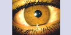 Dry eye normal Dry eye normal