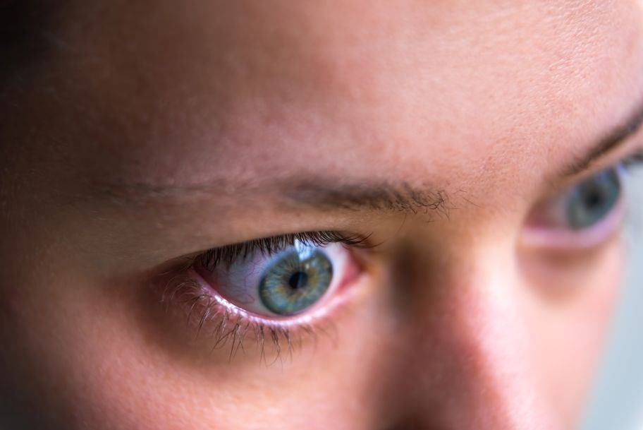 Thyroid Eye Disease Graves