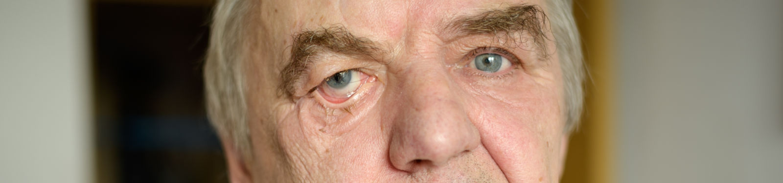facial-nerve-paralysis